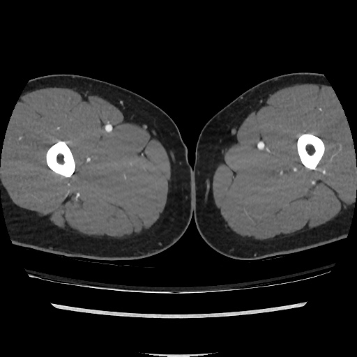 File:Normal CT angiogram of pelvis (Radiopaedia 45390-49430 A 83).jpg