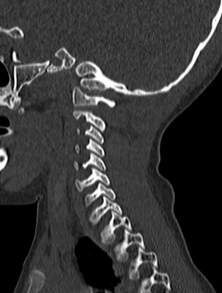 Normal CT cervical spine - pediatric (Radiopaedia 52549-58462 Sagittal bone window 45).jpg