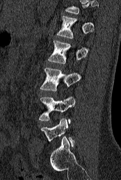 File:Normal CT lumbar spine (Radiopaedia 53981-60118 Sagittal bone window 67).jpg