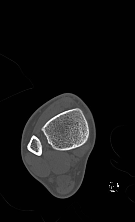 Normal CT of the ankle (Radiopaedia 47111-51658 Axial bone window 21).jpg