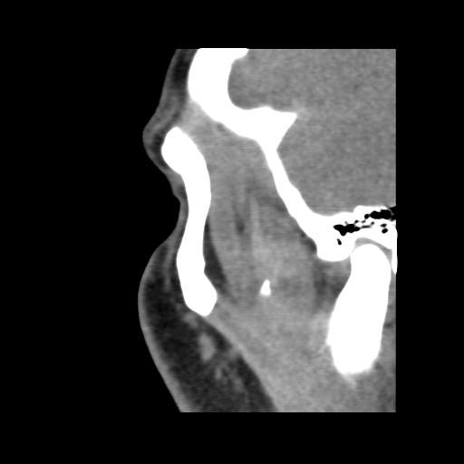 Normal CT paranasal sinuses (Radiopaedia 42286-45390 F 126).jpg