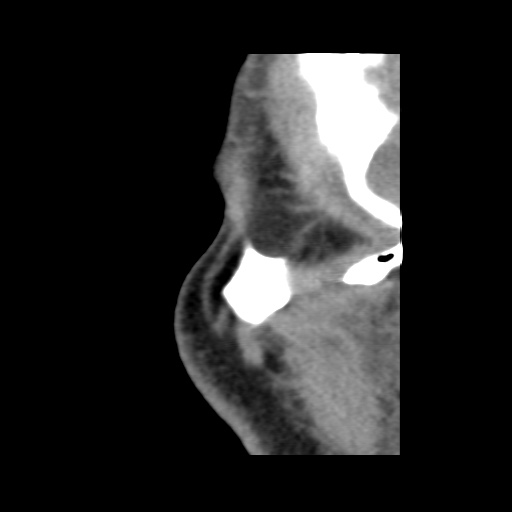 Normal CT paranasal sinuses (Radiopaedia 42286-45390 F 135).jpg