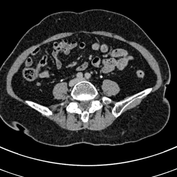 File:Normal CT split bolus study of the renal tract (Radiopaedia 48631-53634 Axial split bolus 175).jpg