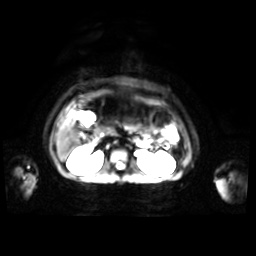 Normal MRI abdomen in pregnancy (Radiopaedia 88001-104541 Axial DWI 36).jpg