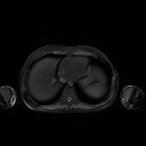 File:Normal MRI abdomen in pregnancy (Radiopaedia 88001-104541 D 7).jpg