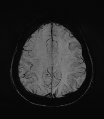 Normal MRI internal auditory canal (Radiopaedia 41613-44525 Axial SWI MIP 59).png