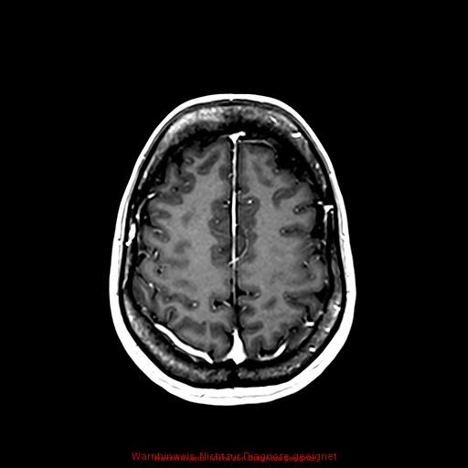 Normal adult brain MRI (non-enhanced and contrast-enhanced) (Radiopaedia 75262-86379 Axial T1 C+ 143).jpg