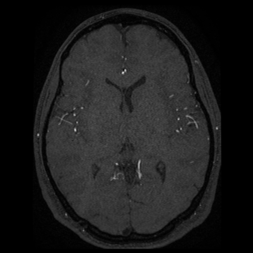 Normal brain MRA (Radiopaedia 41046-43793 Axial MRA 21).png