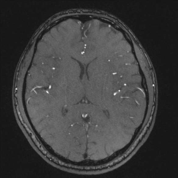 Normal brain MRI including MRA (Radiopaedia 48748-53763 Axial MRA 121).jpg