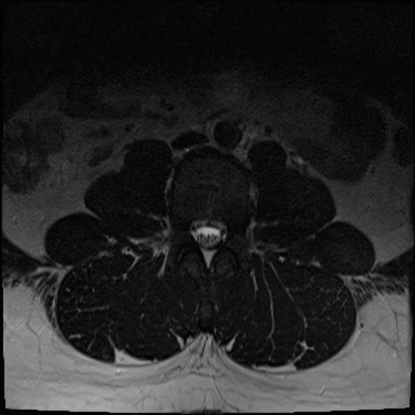 File:Normal lumbar spine MRI (Radiopaedia 47857-52609 Axial T2 1).jpg
