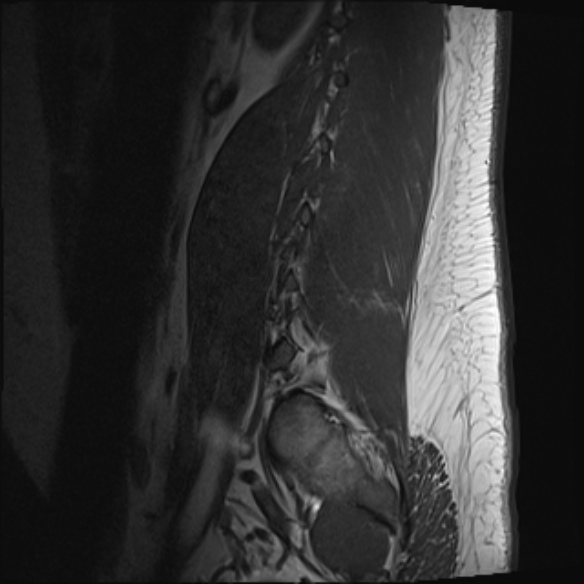 File:Normal lumbar spine MRI (Radiopaedia 47857-52609 Sagittal T1 19).jpg