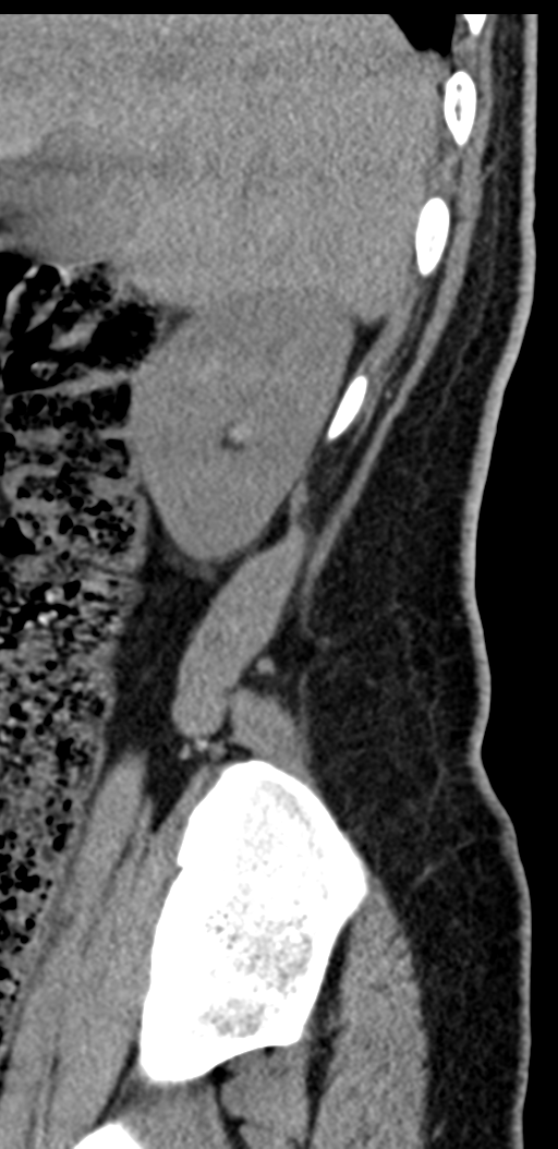 Normal lumbosacral CT (Radiopaedia 37923-39867 E 101).png