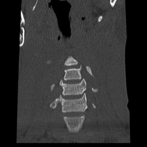 File:Normal trauma cervical spine (Radiopaedia 41017-43760 Coronal bone window 7).png