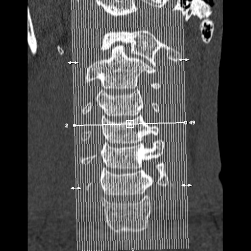 File:Normal trauma cervical spine (Radiopaedia 41017-43760 Sagittal bone window 1).png