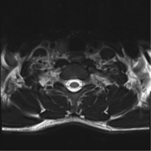 Normal trauma cervical spine (Radiopaedia 41017-43762 D 52).png