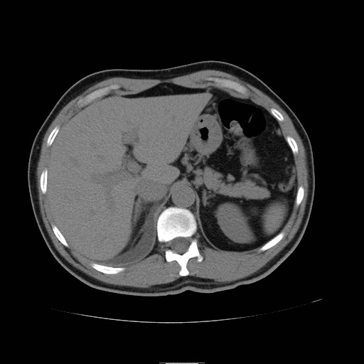 File:Obstructed kidney with perinephric urinoma (Radiopaedia 26889-27066 Axial non-contrast 5).jpg