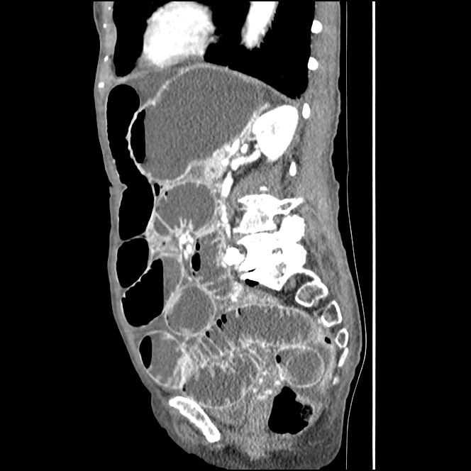 Obturator hernia causing small bowel obstruction (Radiopaedia 65522-74612 C 38).jpg