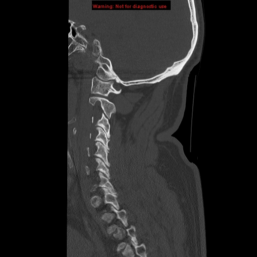 File:Occipital condyle fracture (Radiopaedia 18366-18208 Sagittal bone window 27).jpg