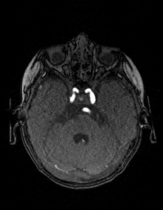 Occipital horn syndrome (Radiopaedia 14255-14129 MRA 45).jpg