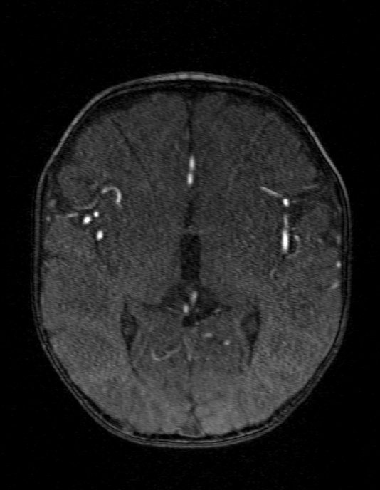 Occipital horn syndrome (Radiopaedia 14255-14129 MRA 82).jpg