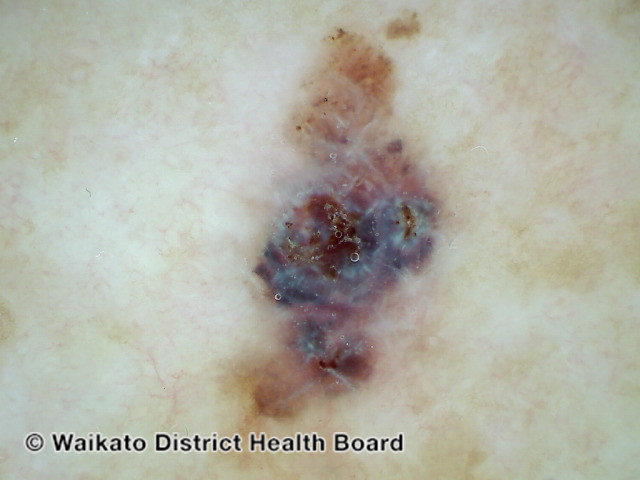 File:Polarised dermoscopy of melanoma (DermNet NZ polarised-melanoma).jpg