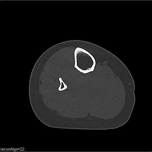 File:ACL avulsion fracture (Radiopaedia 33833-34994 Axial bone window 37).jpg