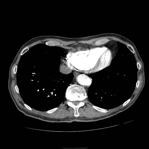 File:Abdominal aortic aneurysm (Radiopaedia 13341-13340 Axial C+ arterial phase 1).jpg