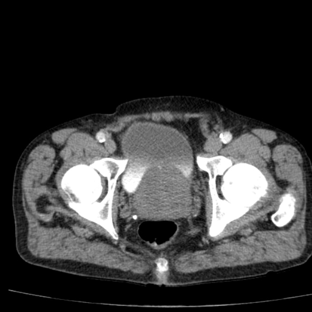 Abdominal aortic aneurysm (Radiopaedia 29248-29660 Axial C+ arterial phase 87).jpg