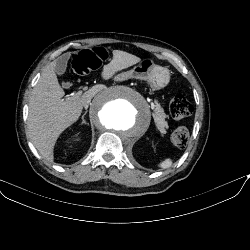 File:Abdominal aortic aneurysm (Radiopaedia 67117-76452 Axial C+ arterial phase 34).jpg