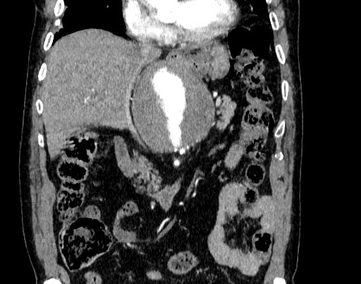 Abdominal aortic aneurysm (Radiopaedia 67117-76452 Coronal C+ arterial phase 36).jpg