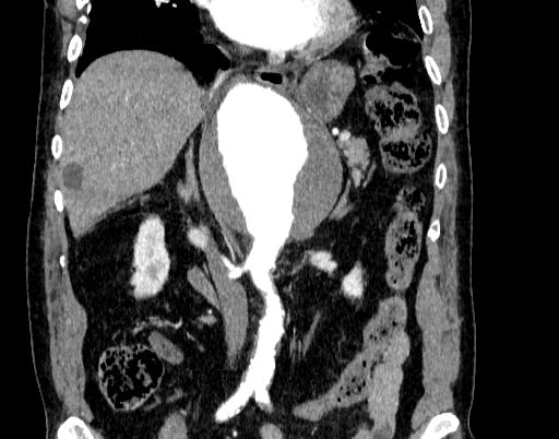 Abdominal aortic aneurysm (Radiopaedia 67117-76452 Coronal C+ arterial phase 47).jpg