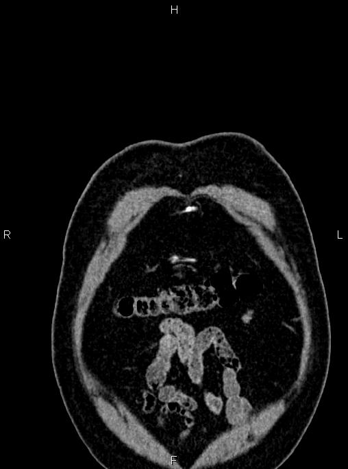 Abdominal aortic aneurysm (Radiopaedia 83094-97462 Coronal renal cortical phase 10).jpg
