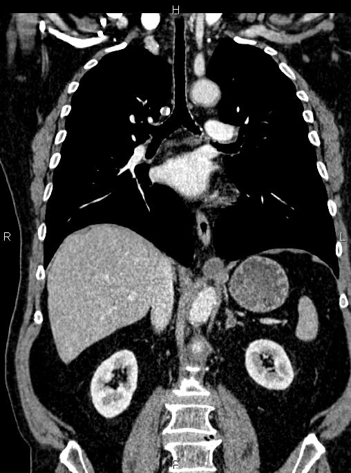 Abdominal aortic aneurysm (Radiopaedia 83094-97462 Coronal renal cortical phase 54).jpg