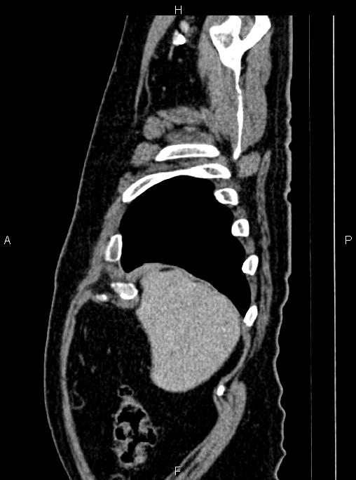 Abdominal aortic aneurysm (Radiopaedia 83094-97462 Sagittal renal cortical phase 18).jpg