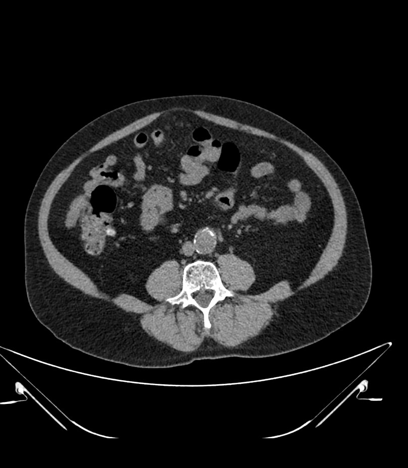 Abdominal aortic aneurysm with thrombus fissuration (Radiopaedia 46218-50618 Axial non-contrast 31).jpg