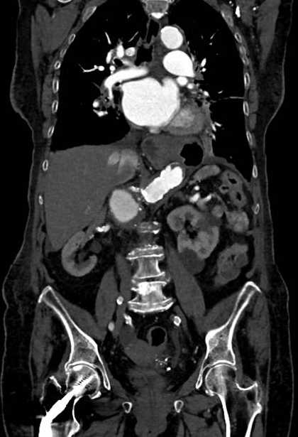Abdominal aortic aneurysm with thrombus fissuration (Radiopaedia 73192-83919 Coronal C+ arterial phase 47).jpg
