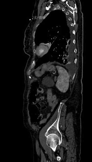Abdominal aortic aneurysm with thrombus fissuration (Radiopaedia 73192-83919 Sagittal C+ arterial phase 21).jpg