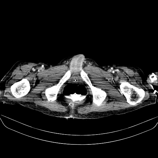 File:Abdominal collection due to previous cecal perforation (Radiopaedia 80831-94320 Axial C+ portal venous phase 219).jpg