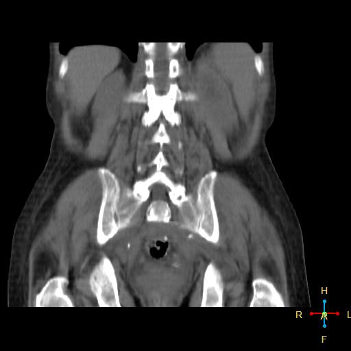 File:Abdominal lymphoma (Radiopaedia 23085-23115 Coronal non-contrast 2).jpg