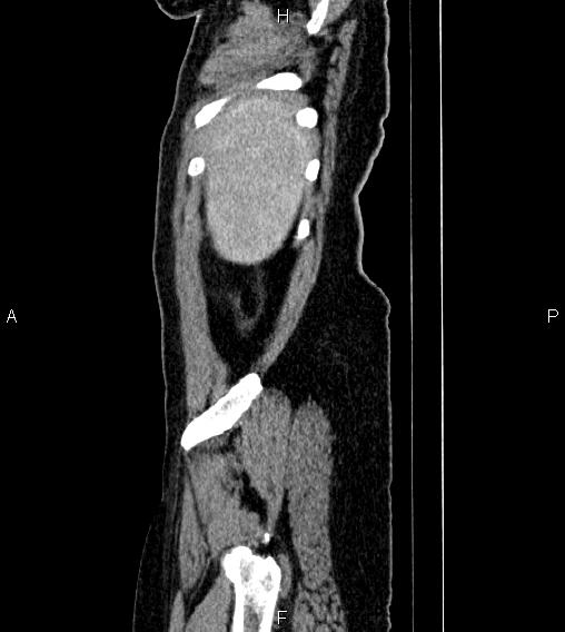 Abdominal lymphoma with sandwich sign (Radiopaedia 84378-99704 Sagittal C+ portal venous phase 88).jpg