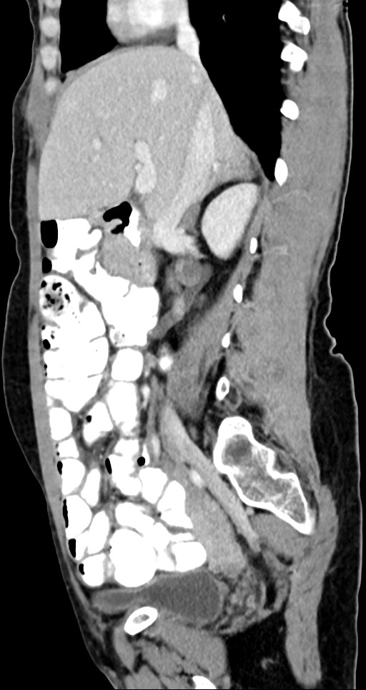 Abdominal wall and retroperitoneal tuberculosis (Radiopaedia 88137-104729 Sagittal C+ portal venous phase 93).jpg