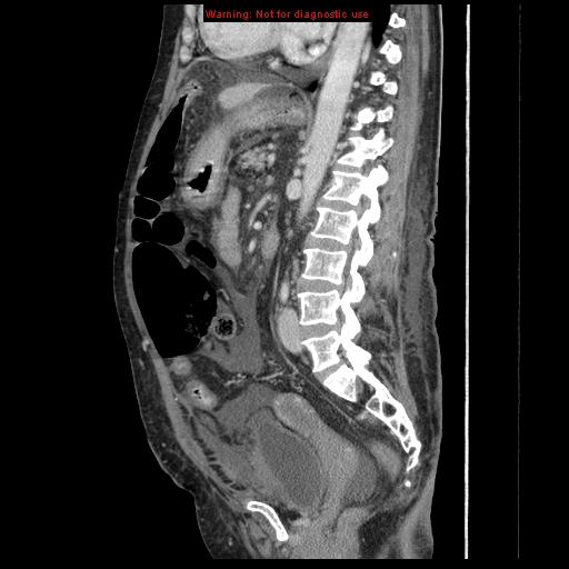 Abdominal wall hematoma (Radiopaedia 9427-10112 Sagittal C+ portal venous phase 47).jpg