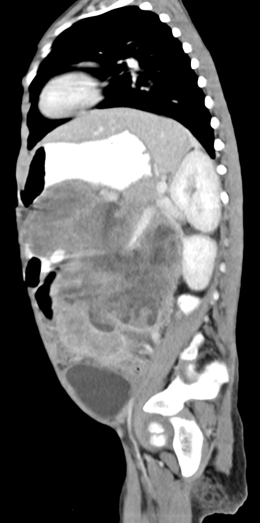 Abdominopelvic rhabdomyosarcoma (Radiopaedia 78356-90984 Sagittal C+ portal venous phase 32).jpg