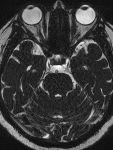 Abducens nerve palsy (Radiopaedia 57084-63976 Axial T2 ciss 3d 41).jpg