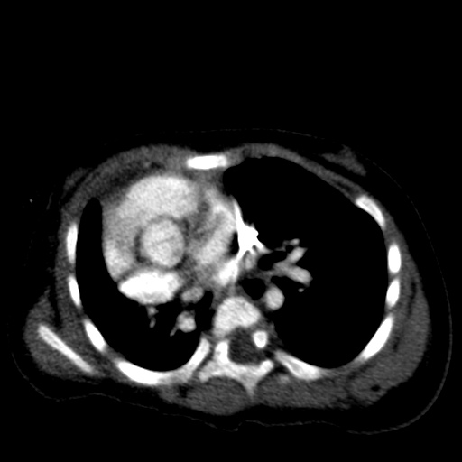 Aberrant left pulmonary artery (pulmonary sling) (Radiopaedia 42323-45435 Axial C+ CTPA 23).jpg