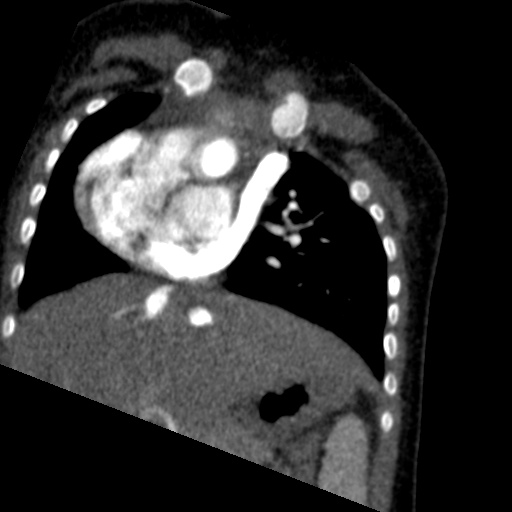 File:Aberrant left pulmonary artery (pulmonary sling) (Radiopaedia 42323-45435 Coronal C+ CTPA 16).jpg