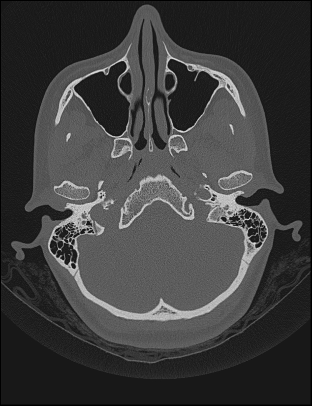 Aberrant right internal carotid artery (Radiopaedia 65191-74198 Axial non-contrast 27).jpg