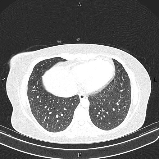File:Aberrant right subclavian artery (Radiopaedia 87334-103629 Axial lung window 49).jpg