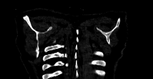 Accesory rib joint (Radiopaedia 71987-82452 Coronal bone window 88).jpg