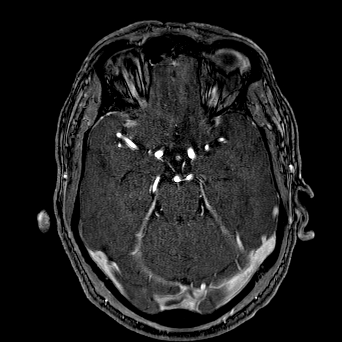 Accessory middle cerebral artery (Radiopaedia 73114-83828 Axial MRA 66).jpg
